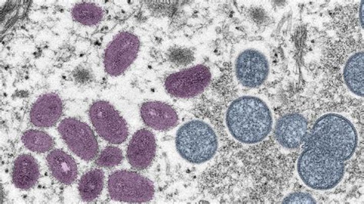 Tragic Loss: Immunocompromised Texan Succumbs To Monkeypox