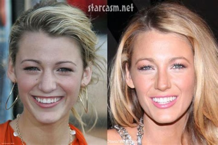 Blake Lively's Transformation: Before And After Her Alleged Nose Job