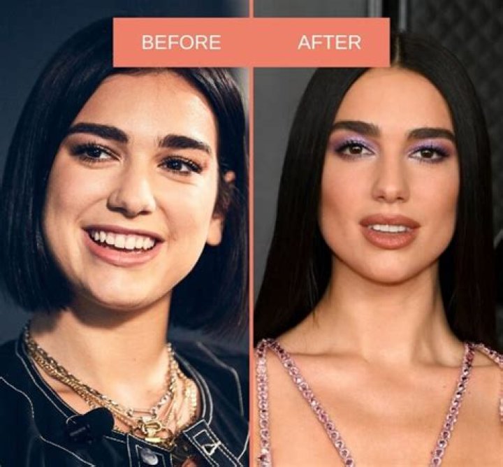 Dua Lipa Nose Job Did She Underwent Surgery? Before And After