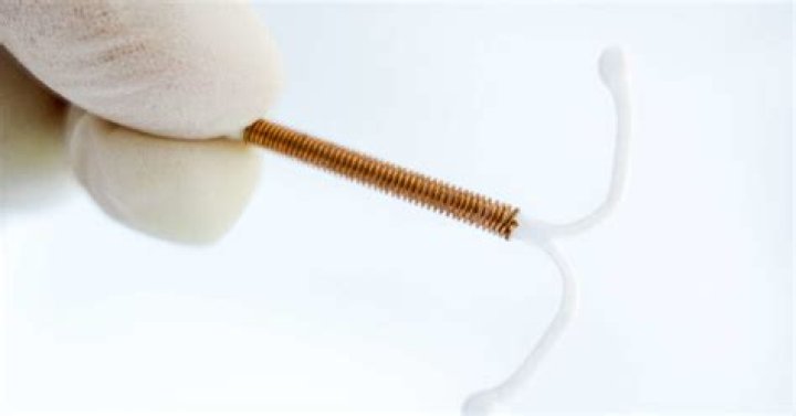 Uncover The Impact Of IUDs On Gut Health: A Comprehensive Guide