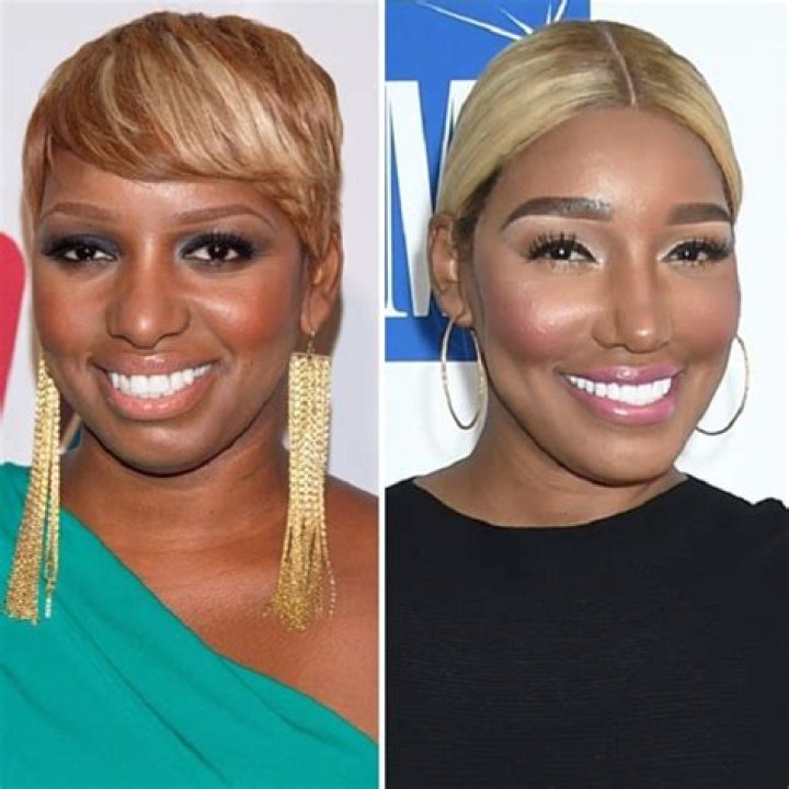 NeNe Leakes Plastic Sugery Pics: Before & After