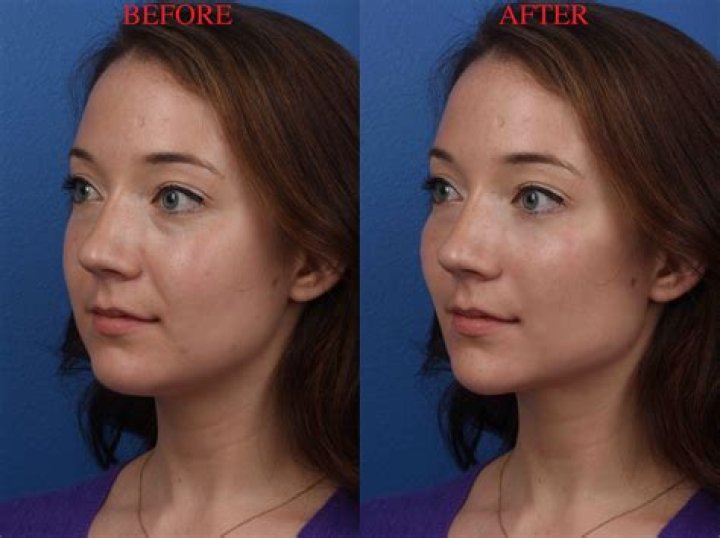 Unveiling The Secrets Of Plastic Surgery: Before And After SB19