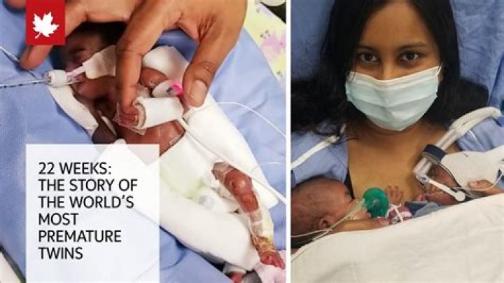 Essential Guide To Understanding Premature Birth Stories