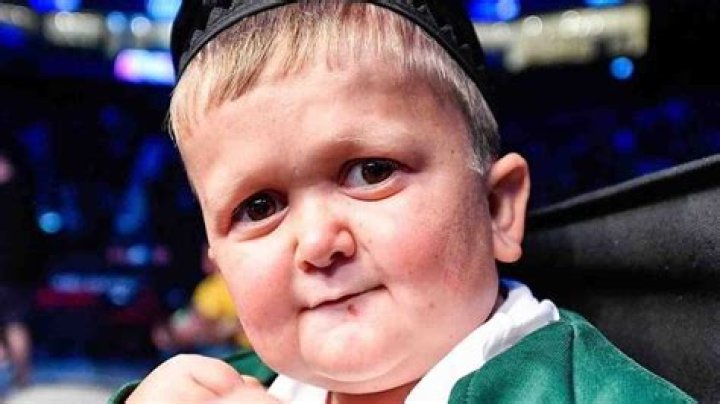 Unveiling Hasbulla's Unique Condition: Discoveries And Insights Revealed